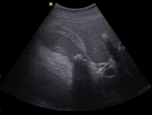 Ultrassom do abdome total com pedra na vesícula