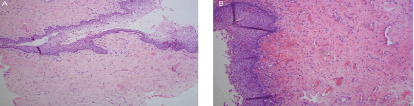 laser em ginecologia