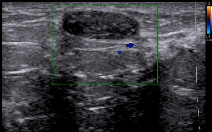 nódulo no ultrassom de mamas