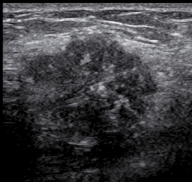 câncer na ultrassonografia de mamas