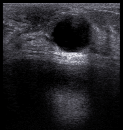 cisto no ultrassom de mamas