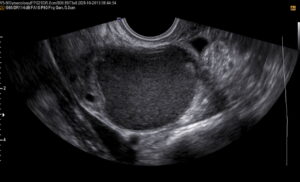 Endometrioma de ovário