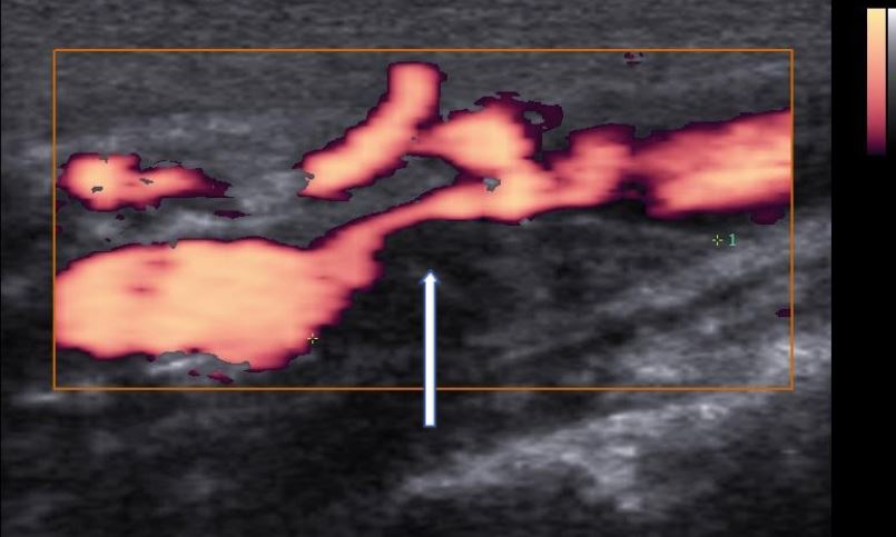 Doppler de artérias carótidas e vetebrais