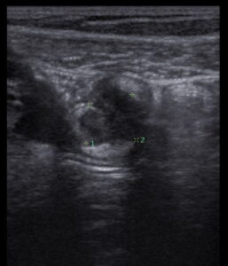 ultrassom especializado pra pesquisa de endometriose