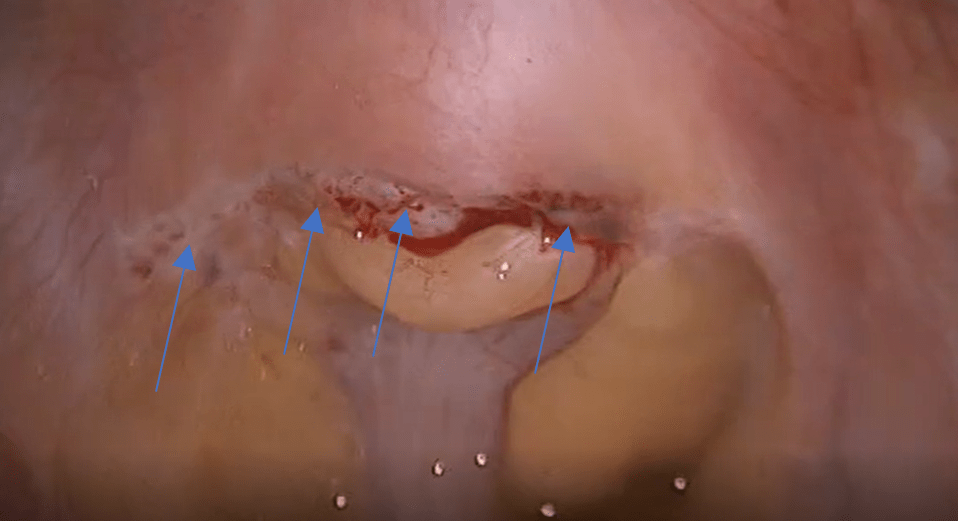 Endometriose profunda retrocervical