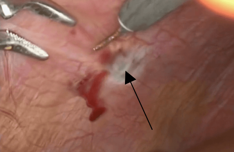 Endometriose profunda no diafragma