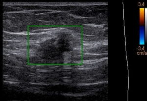 endometriose na cicatriz da cesárea