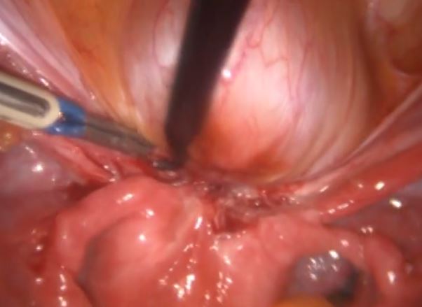 Endometriose na bexiga