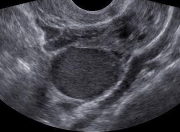 Endometriose ovariana