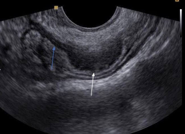 Endometriose intestinal