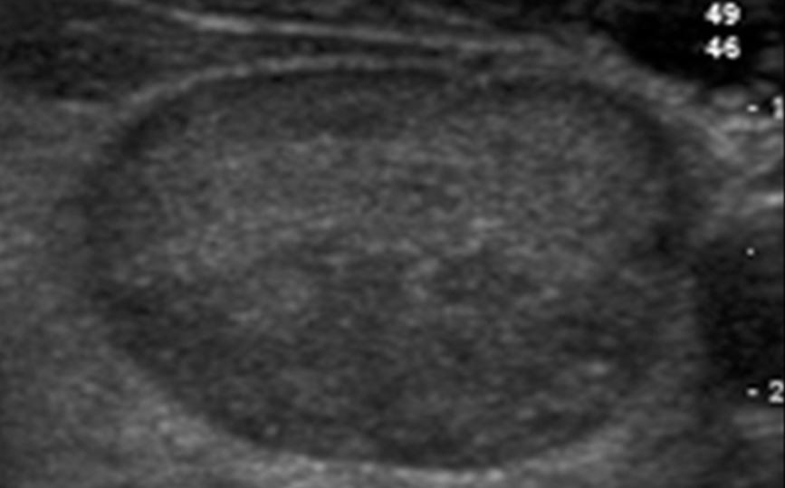 Ultrassom da tireoide