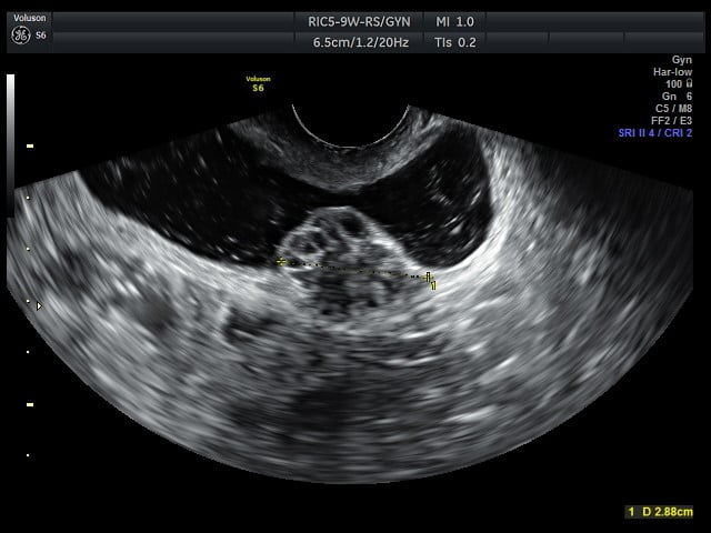 sintomas de endometriose