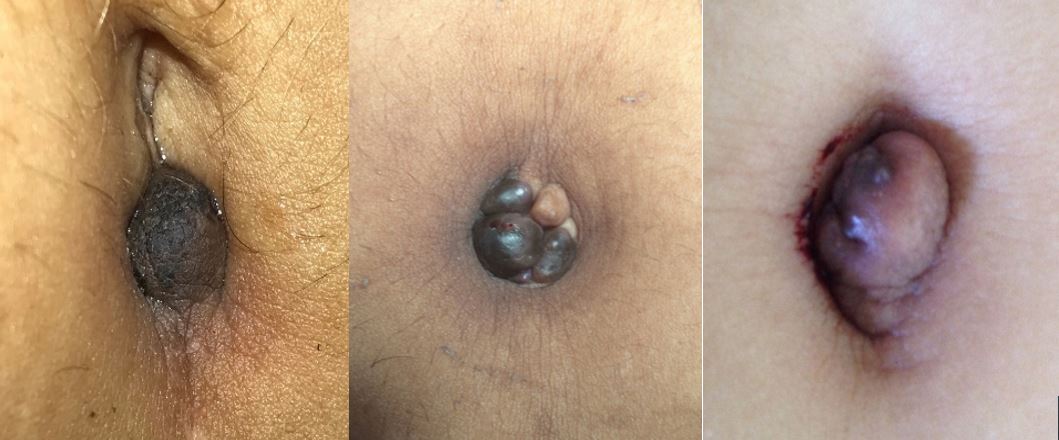 endometriose umbilical