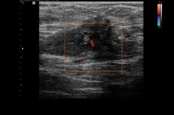 dor na cicatriz da cesárea