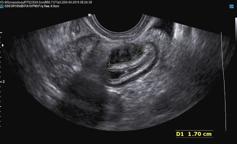 sintomas de endometriose
