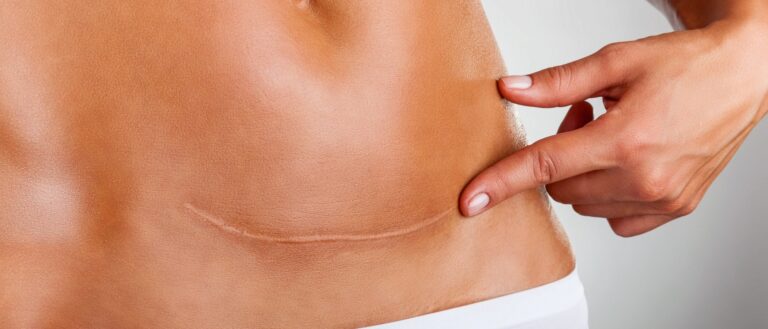 endometriose na cicatriz da cesárea