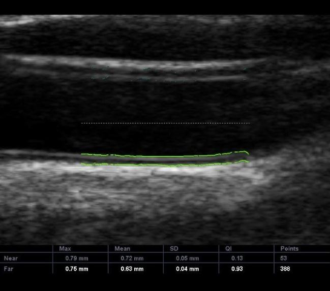 medida da espessura mediointimal