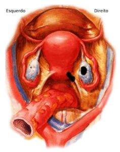 Ultrassom transvaginal com preparo intestinal