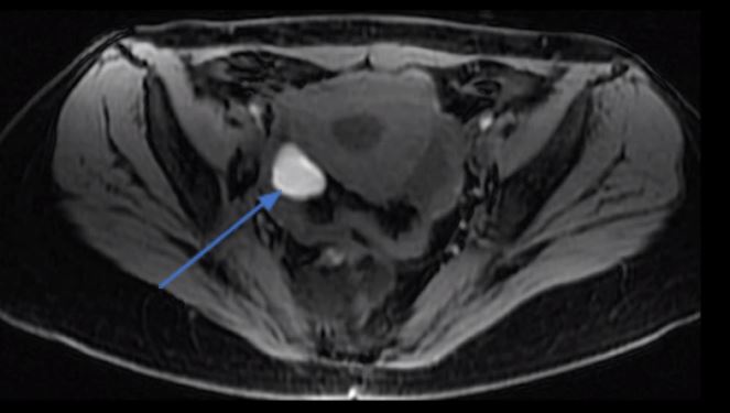 Endometriose ovariana