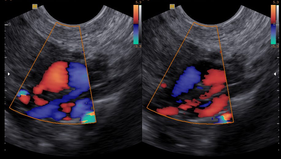 cólica menstrual muito forte