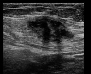Endometriose de cicatriz de cesárea