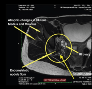 Endometriose no Ciático