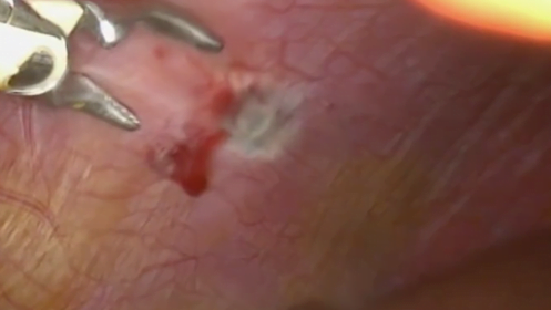 Endometriose no Diafragma