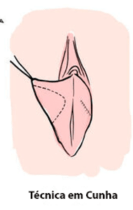 ninfoplastia