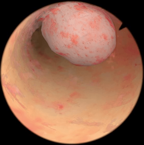 Pólipo endometrial na hisperoscopia