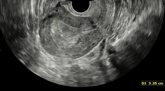 Espessamento endometrial