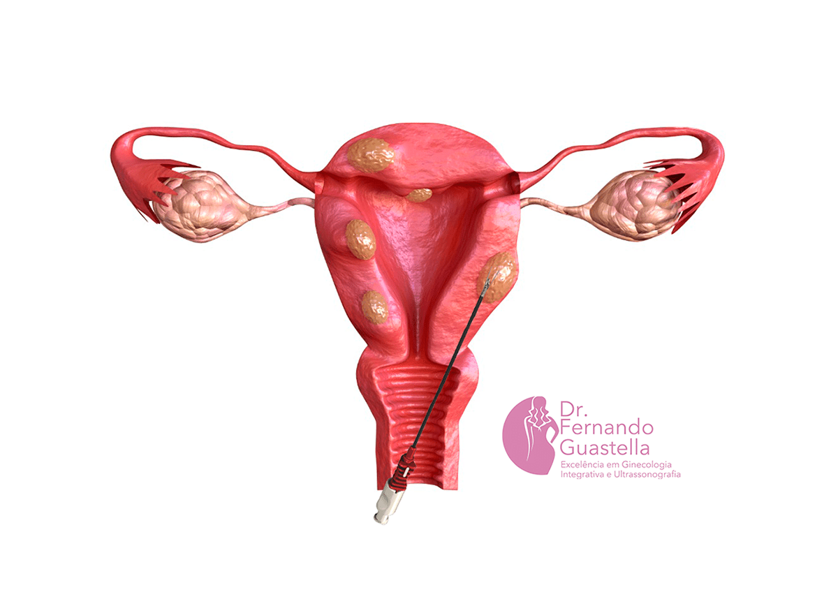 Especialista em Radiofrequência de Mioma Uterino