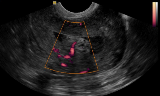 Ginecologista especialista em pólipo endometrial