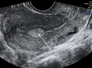 pólipo endometrial e câncer