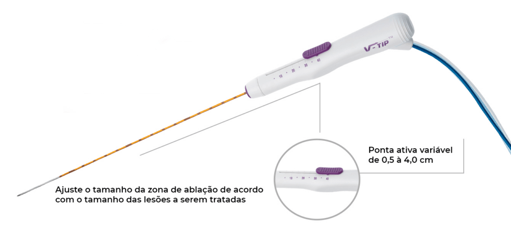 Radiofrequência de Mioma Uterino