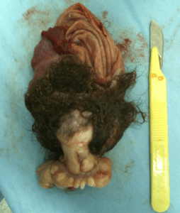 teratoma de ovário fotos