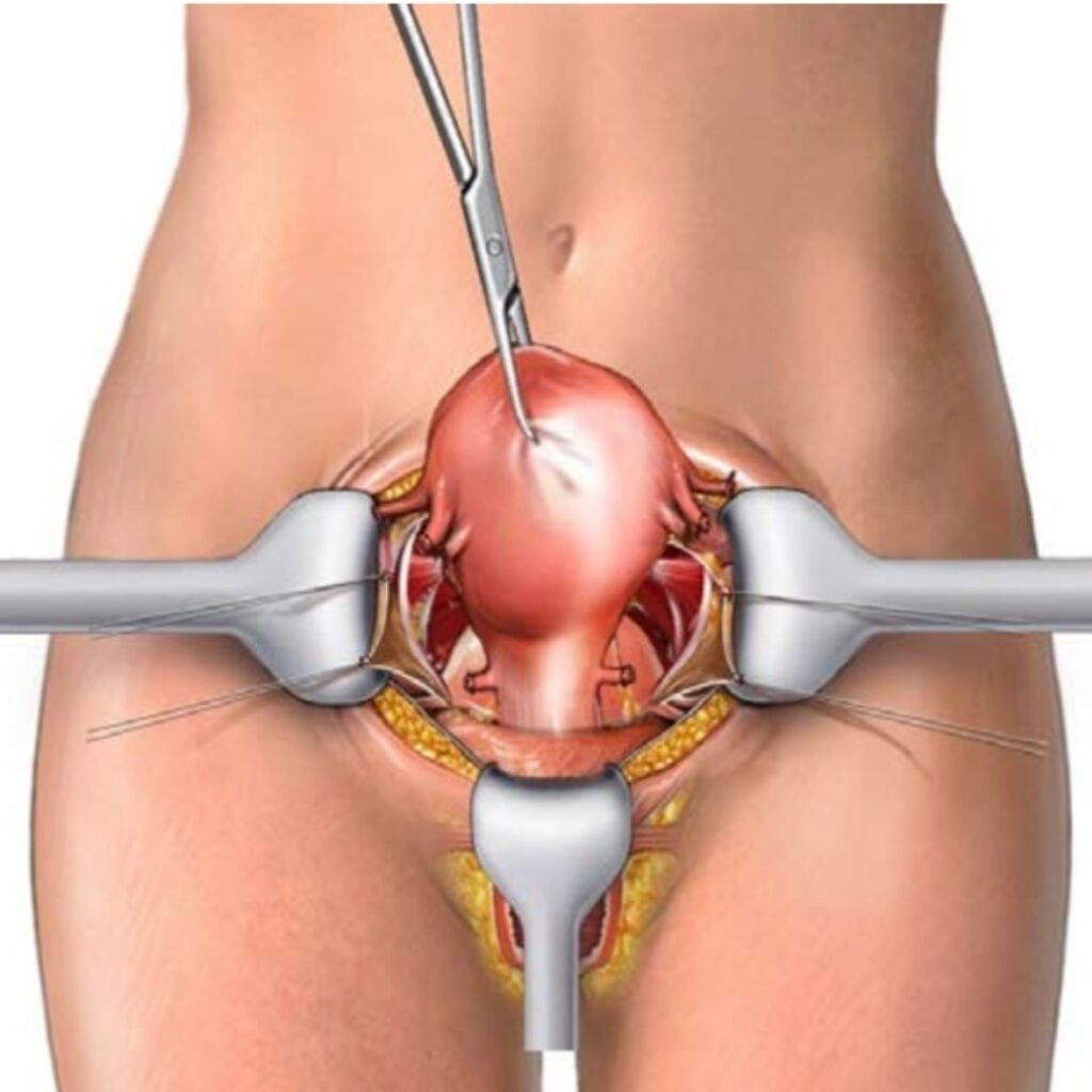 Histerectomia aberta