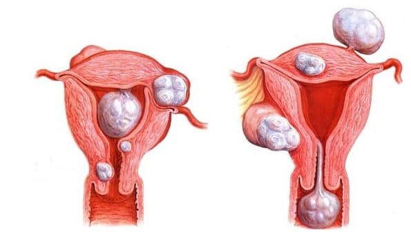 Ginecologista Especialista em Miomectomia