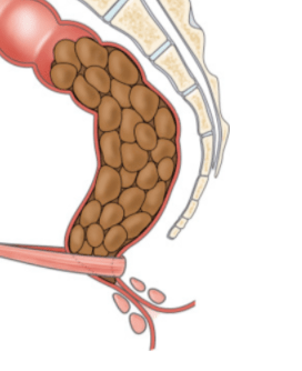 intestino preso após cirurgia
