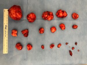 Cirurgia robótica em ginecologia