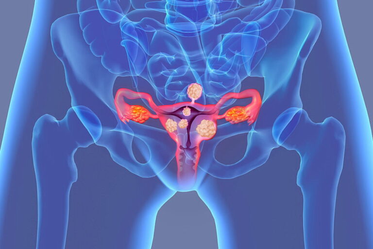 Ginecologista especialista em Miomectomia cirurgica
