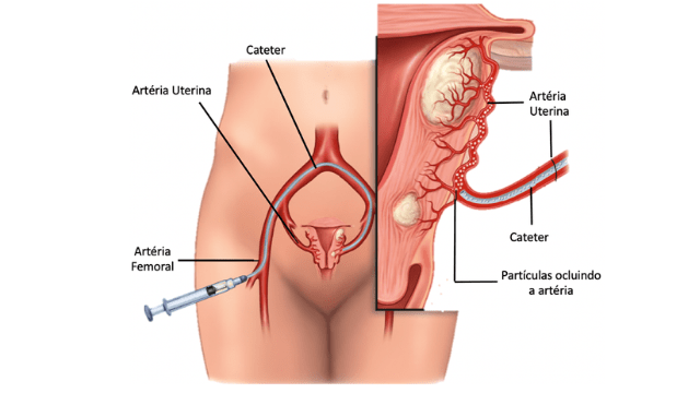 Embolização para o tratamento miomas