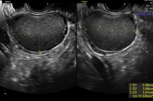 alcoolização de endometrioma antes do tratamento