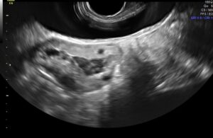 Alcoolização de endometrioma após o tratamento
