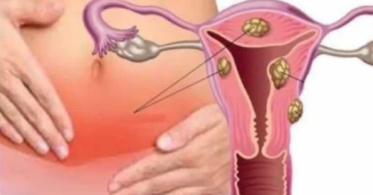 Mioma: Converse com Nossos Especialistas e conheça sobre o Tratamento