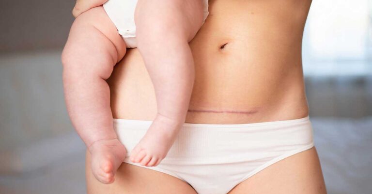 Tratamento para Endometriose na Cicatriz da Cesárea